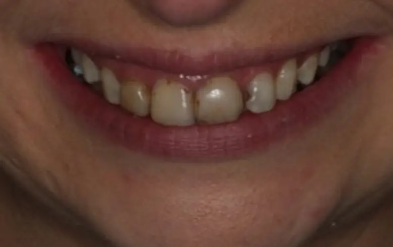 Close-up of a person's smile showing uneven teeth, discoloration, and gaps, highlighting dental transformation potential at NuSmile Implant Studio.