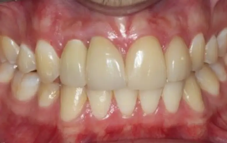 Close-up of a dental smile transformation showcasing even, bright teeth and healthy gums, highlighting cosmetic dentistry results at NuSmile Implant Studio.