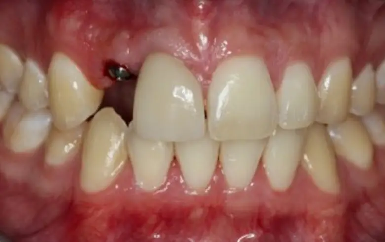 Before-and-after image of dental transformation showcasing teeth restoration and cosmetic dentistry results at NuSmile Implant Studio.
