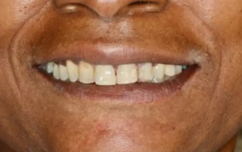 Close-up of a person's smile showcasing dental imperfections, highlighting the need for cosmetic dentistry services at NuSmile Implant Studio.