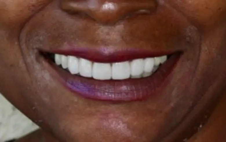 Smiling woman showcasing bright, white teeth after dental transformation at NuSmile Implant Studio.