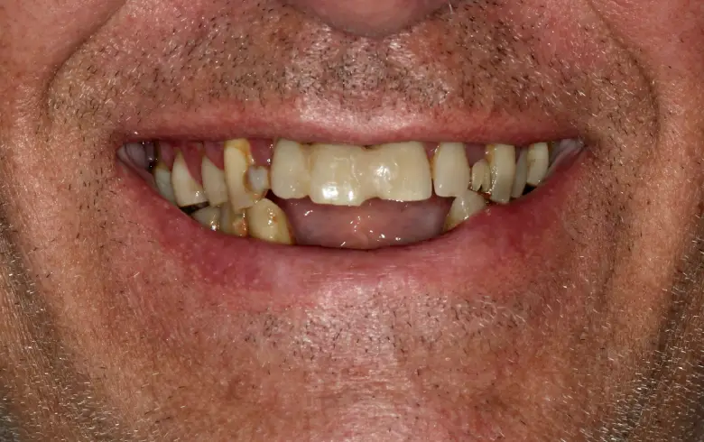 Close-up of a man's smile showing discolored and misaligned teeth, illustrating the need for dental transformation at NuSmile Implant Studio.