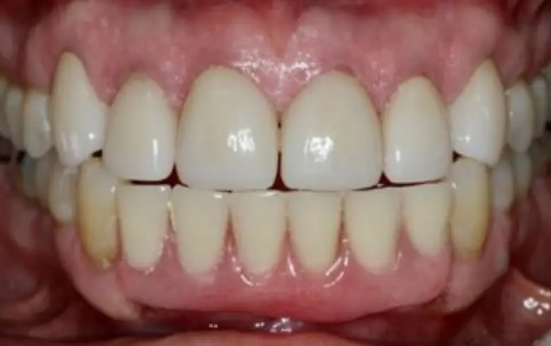 Close-up of a transformed smile showcasing bright, white teeth with even alignment, illustrating cosmetic dentistry results at NuSmile Implant Studio.