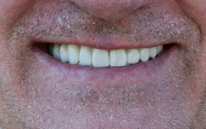 Close-up of a smiling mouth showcasing healthy, white teeth, illustrating dental transformation at NuSmile Implant Studio.