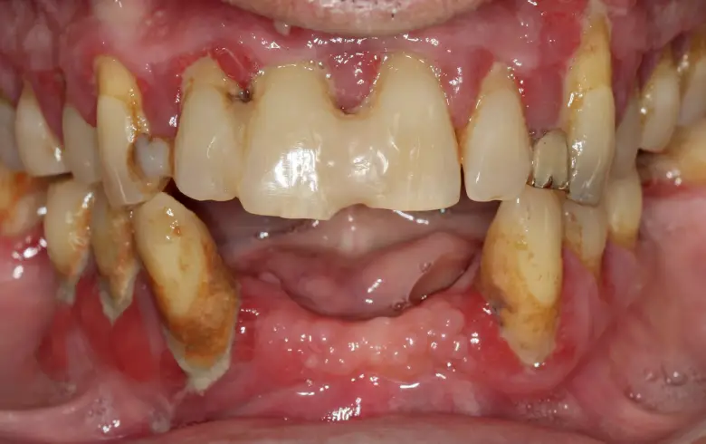 Close-up of damaged teeth showing decay and gum issues, illustrating the need for dental implants and cosmetic dentistry solutions at NuSmile Implant Studio.