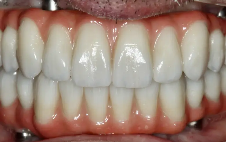 Close-up of a bright, healthy smile showcasing well-aligned, white teeth and healthy gums, highlighting dental transformation results from NuSmile Implant Studio.