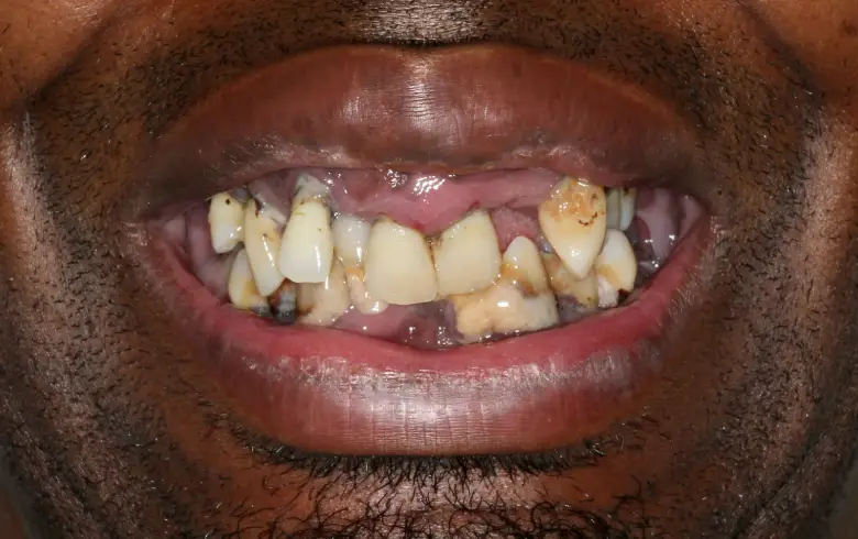 Before-and-after dental transformation showcasing a patient's smile with significant tooth decay and misalignment, emphasizing the need for cosmetic dentistry services at NuSmile Implant Studio.