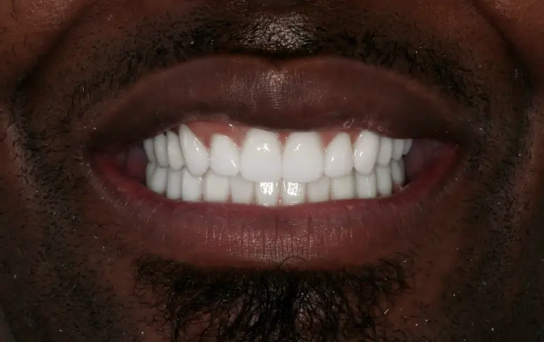 Close-up of a bright, white smile showcasing dental transformation results from NuSmile Implant Studio.