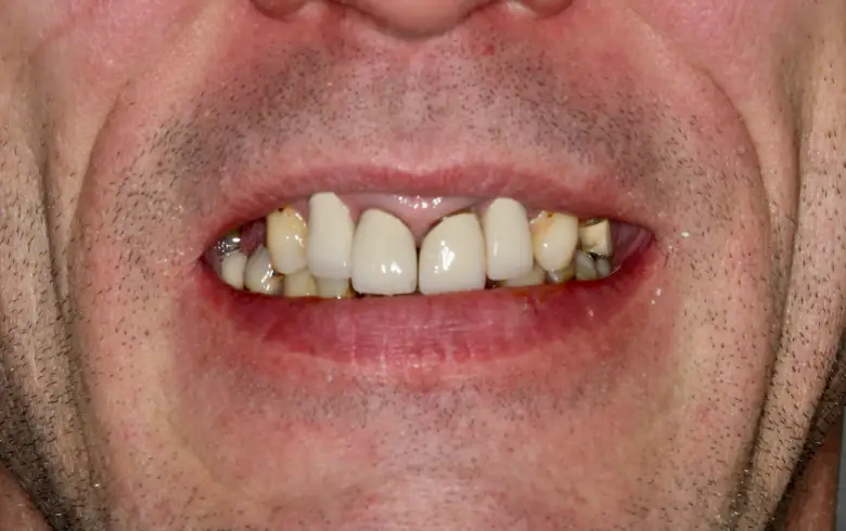 Before-and-after dental transformation showcasing a close-up of a smile with noticeable dental work, highlighting improved aesthetics and oral health at NuSmile Implant Studio.