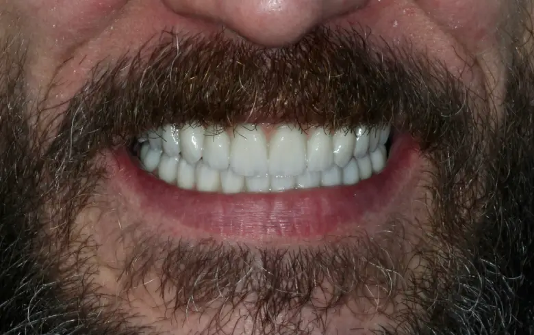 Close-up of a smiling man showcasing bright, white teeth and a full beard, highlighting dental transformation results from NuSmile Implant Studio.