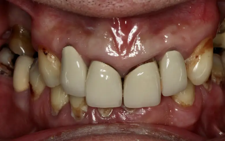 Close-up of a dental transformation showcasing before-and-after results with natural and cosmetic dental work at NuSmile Implant Studio, highlighting improved tooth appearance and alignment.