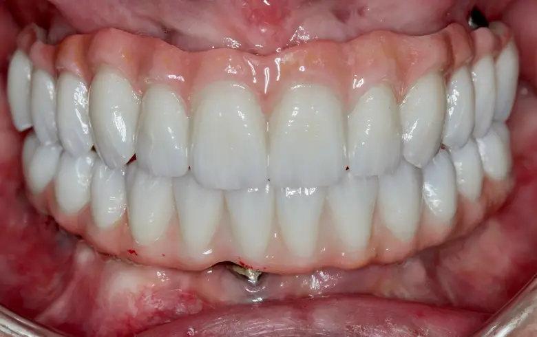 Close-up of a vibrant smile showcasing bright, white teeth and healthy gums, demonstrating successful dental transformation from NuSmile Implant Studio.