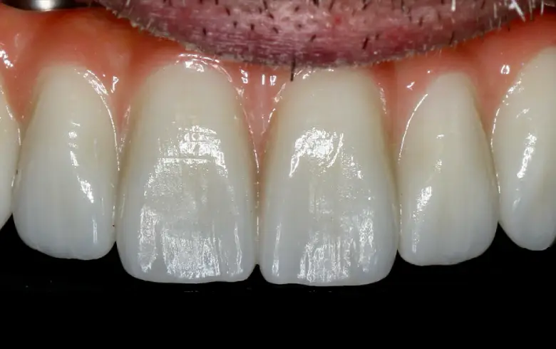 Close-up of polished teeth showcasing dental transformation at NuSmile Implant Studio, emphasizing cosmetic dentistry results.