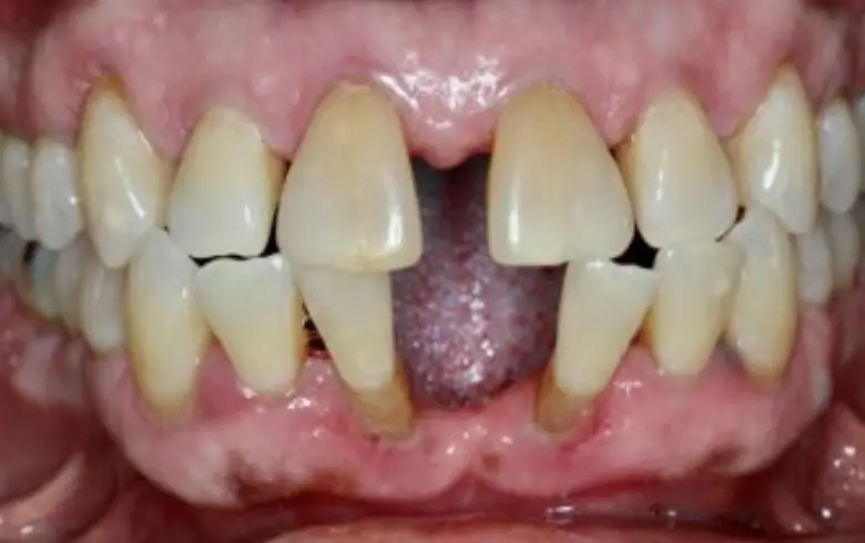 Close-up of teeth showing dental imperfections and gaps, illustrating a dental condition relevant to the smile showcase at NuSmile Implant Studio.