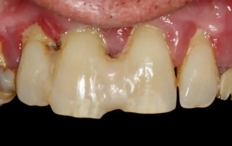Close-up of dental transformation showing two front teeth with noticeable discoloration and gum health issues, emphasizing the need for cosmetic dentistry at NuSmile Implant Studio.
