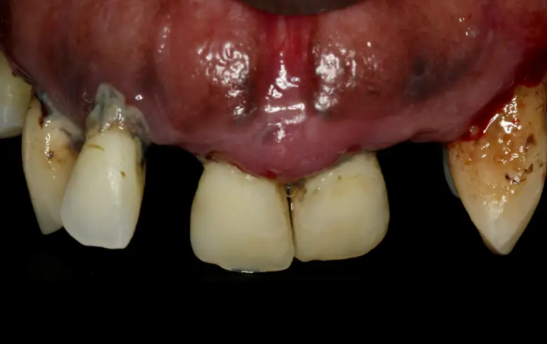 Dental transformation showcasing teeth with gum health issues, highlighting the need for cosmetic dentistry and dental implants at NuSmile Implant Studio.