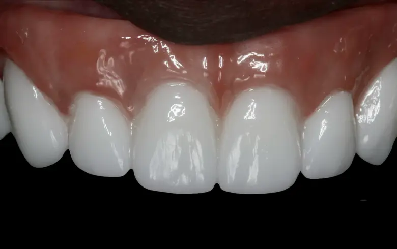 Close-up of a healthy smile showcasing bright, white teeth and healthy gums, illustrating dental transformation results at NuSmile Implant Studio.