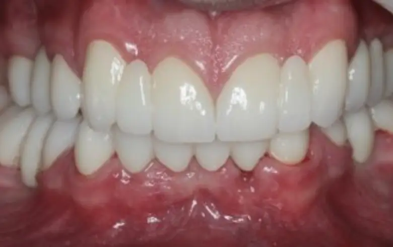 Close-up of a healthy, bright smile showcasing dental implants and cosmetic dentistry results at NuSmile Implant Studio.