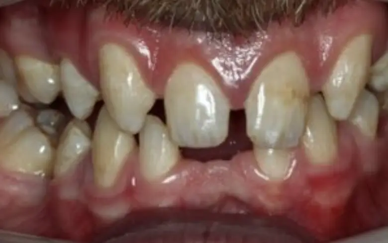 Before-and-after image of a dental transformation showcasing misaligned and discolored teeth, highlighting the need for cosmetic dentistry and dental implants at NuSmile Implant Studio.