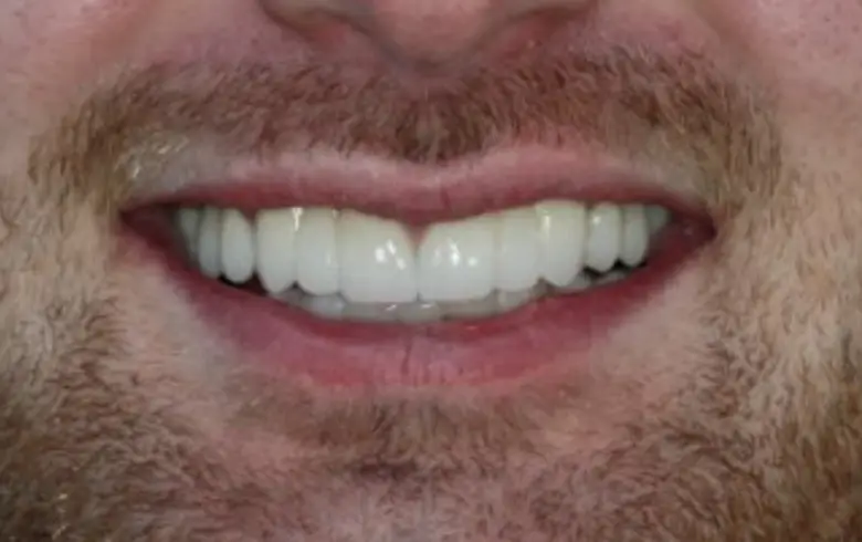 Close-up of a man's smile showcasing bright, white teeth and healthy gums, highlighting successful dental transformation at NuSmile Implant Studio.