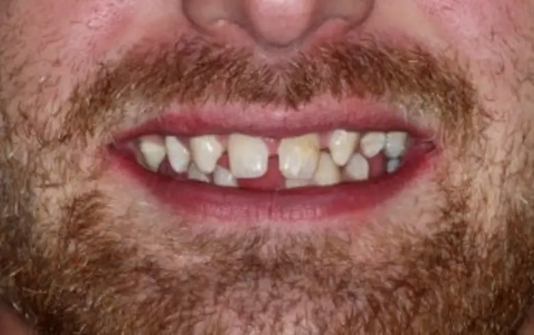 Close-up of a man's smile showing uneven and discolored teeth, highlighting dental imperfections before treatment at NuSmile Implant Studio.