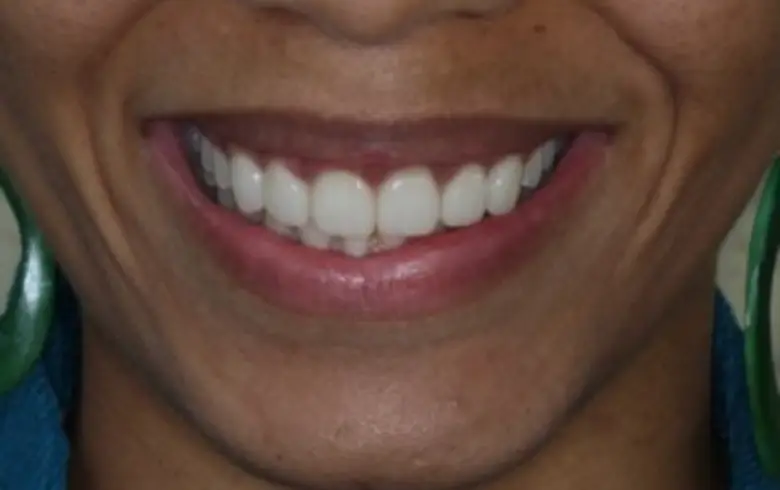 Smiling individual showcasing bright, straight teeth highlighting cosmetic dentistry results at NuSmile Implant Studio.