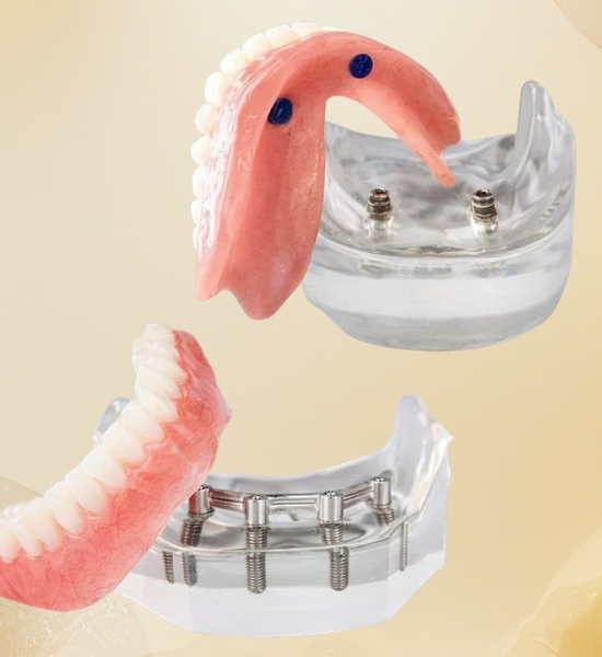 Implant-supported dentures showcasing dental implants, demonstrating stability and comfort for enhanced chewing and speaking.