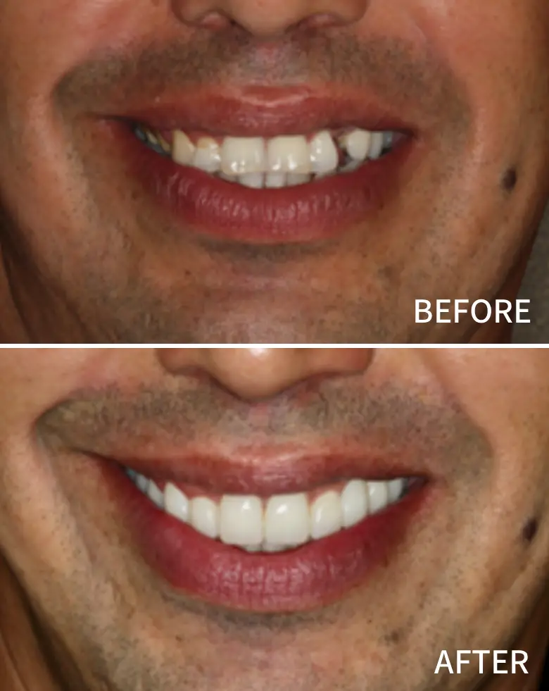 Before-and-after images showcasing smile transformation, highlighting anterior tooth loss and successful restoration for enhanced aesthetics.