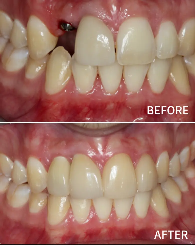 Before-and-after image showcasing dental transformation, highlighting anterior tooth loss and diastema correction, demonstrating successful full mouth rehabilitation.