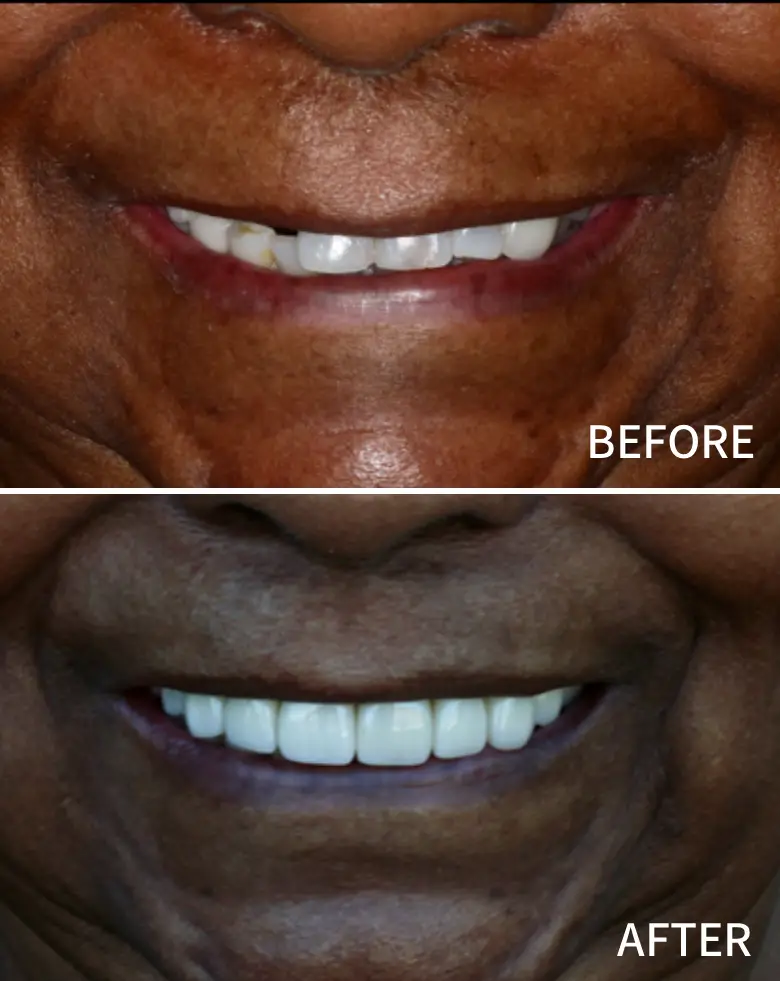 Before-and-after images of a smile transformation, showcasing improved anterior teeth alignment and aesthetic restoration, highlighting successful cosmetic dentistry at NuSmile Implant Studio.