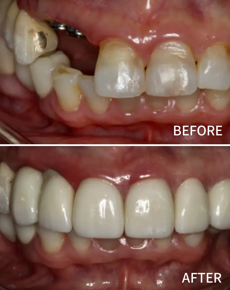 Before-and-after dental transformation showcasing anterior tooth restoration, addressing diastema and multiple failing restorations, highlighting improved smile aesthetics.