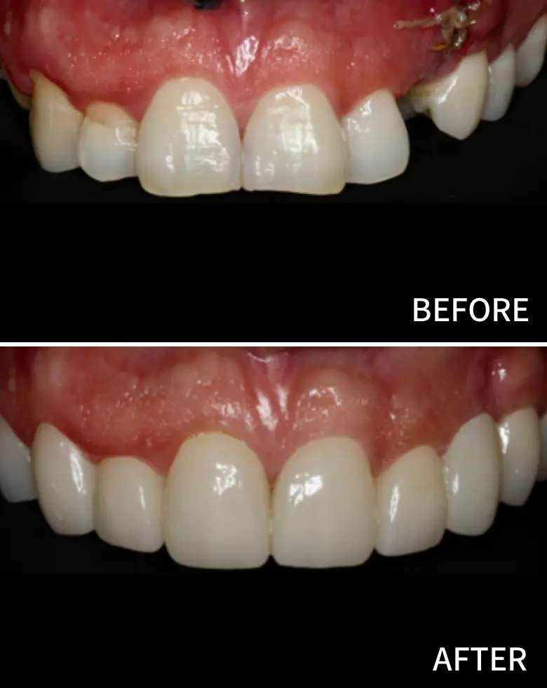 Before-and-after image showcasing dental transformation, highlighting anterior tooth restoration and correction of diastema at NuSmile Implant Studio.