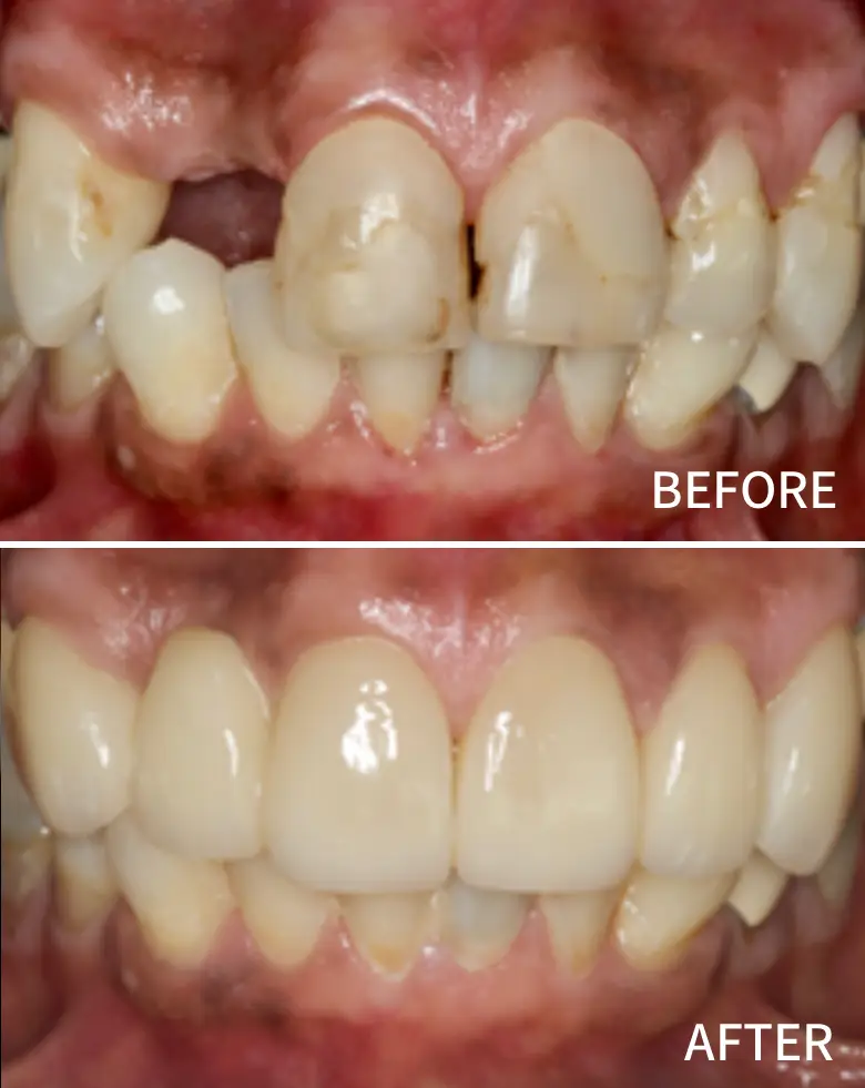 Before-and-after dental transformation showcasing anterior tooth restoration, highlighting diastema correction and improved smile aesthetics.