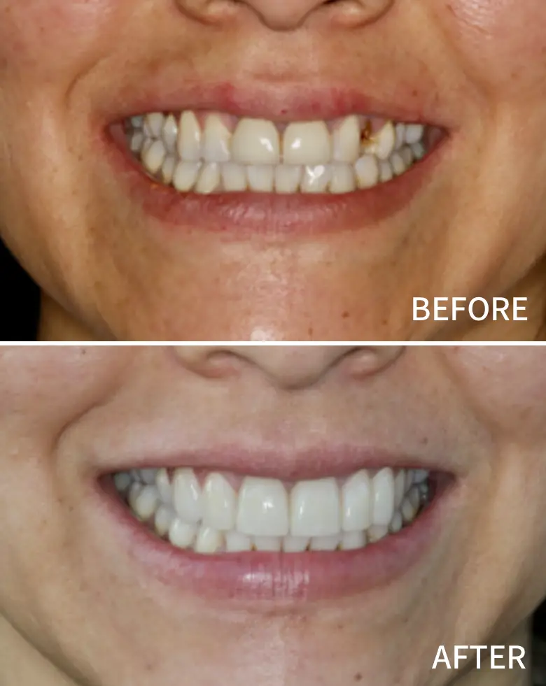 Before-and-after image of a dental transformation showcasing anterior tooth restoration, highlighting improved smile aesthetics and closure of diastema.