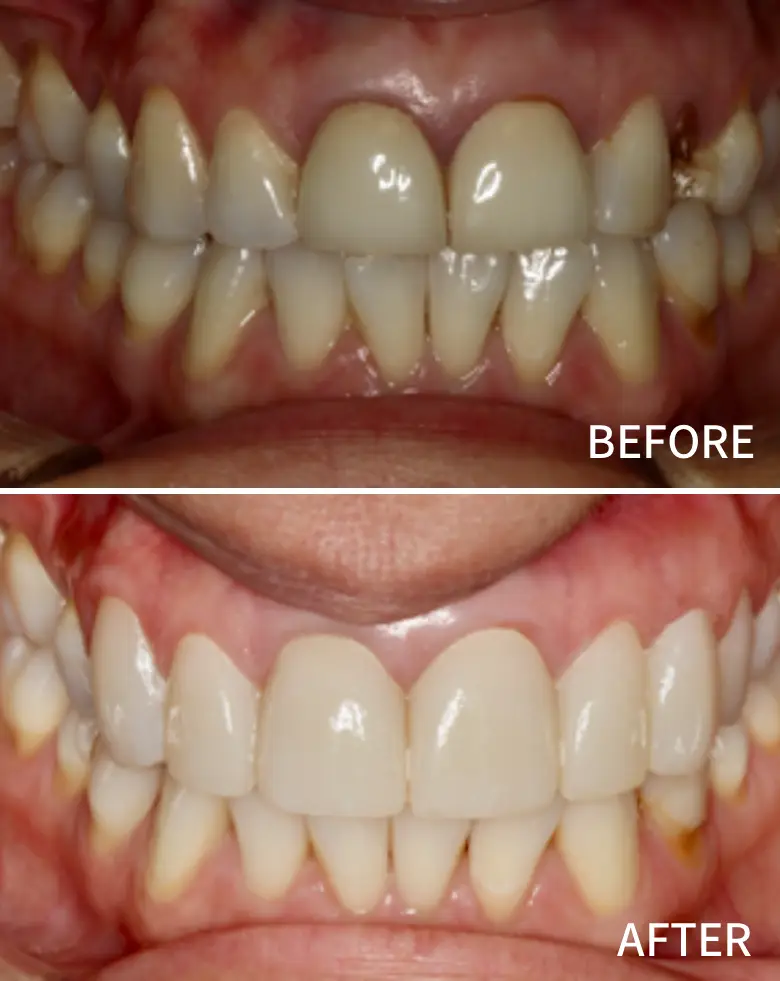 Before-and-after image showcasing dental transformation, highlighting diastema closure and anterior tooth restoration, related to smile makeovers at NuSmile Implant Studio.