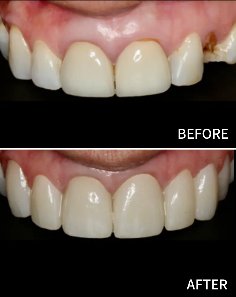 Before-and-after image showcasing dental transformation, highlighting anterior tooth restoration, addressing diastema, and improving smile aesthetics.