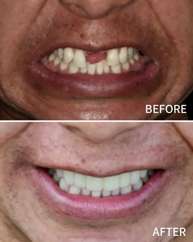 Before-and-after images of a dental transformation showcasing significant improvement in anterior tooth aesthetics, addressing diastema and anterior tooth loss, highlighting effective restorative dentistry by NuSmile Implant Studio.