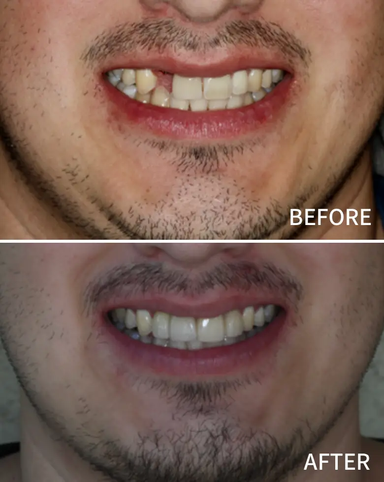Before and after images of a smile transformation showcasing diastema correction and improved anterior tooth aesthetics at NuSmile Implant Studio.
