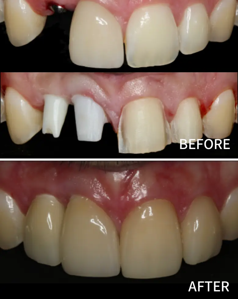 Before-and-after images of anterior tooth restoration, showcasing diastema closure and cosmetic enhancement of smile at NuSmile Implant Studio.