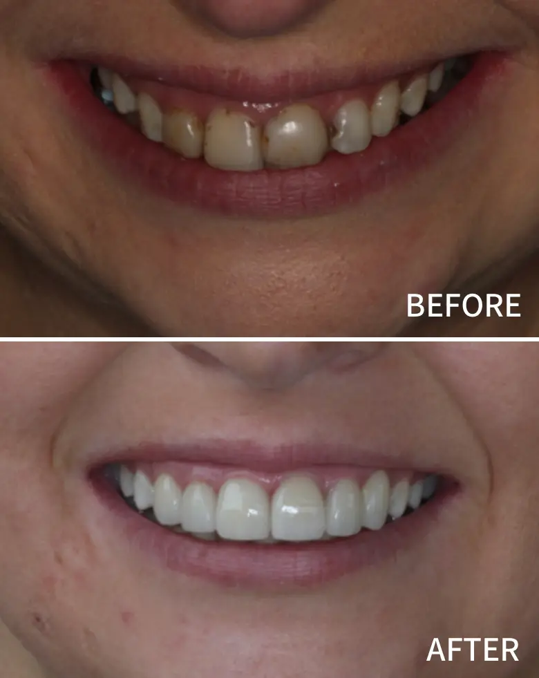 Before-and-after image showcasing a smile transformation, highlighting improvements in anterior tooth alignment and restoration, addressing diastema and generalized tooth wear.