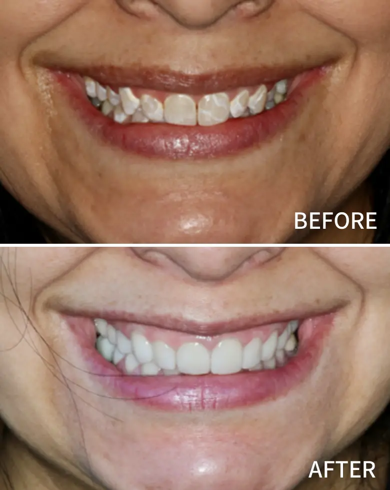 Before-and-after dental transformation showcasing improved smile aesthetics, highlighting resolution of diastema and anterior tooth loss with enhanced tooth alignment and color.