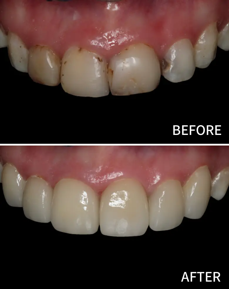 Before-and-after comparison of dental restoration showcasing improved anterior teeth aesthetics, addressing diastema and tooth wear, highlighting successful smile transformation at NuSmile Implant Studio.
