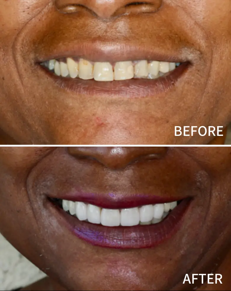 Before-and-after image of a smile transformation showcasing improved dental aesthetics, highlighting restoration of anterior teeth and correction of diastema.