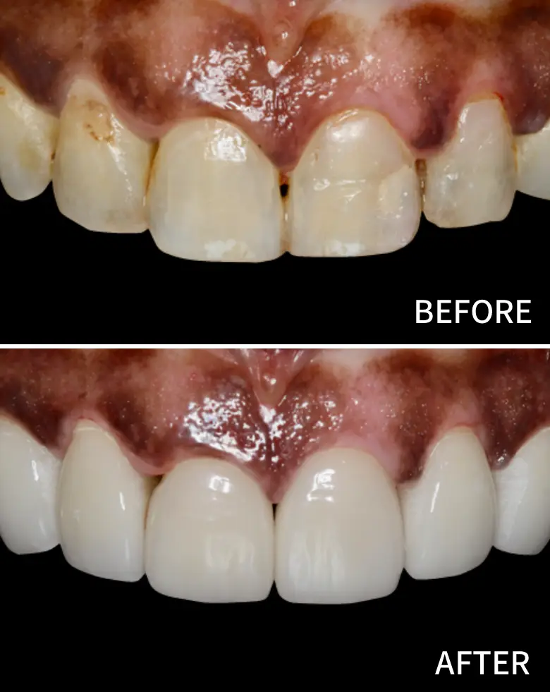 Before-and-after comparison of anterior teeth showcasing successful restoration, highlighting treatment of diastema and improved dental aesthetics.