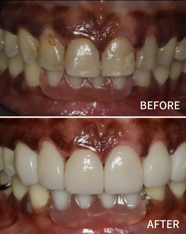 Before-and-after dental transformation showcasing improved anterior teeth alignment, restoration of tooth aesthetics, and correction of diastema at NuSmile Implant Studio.