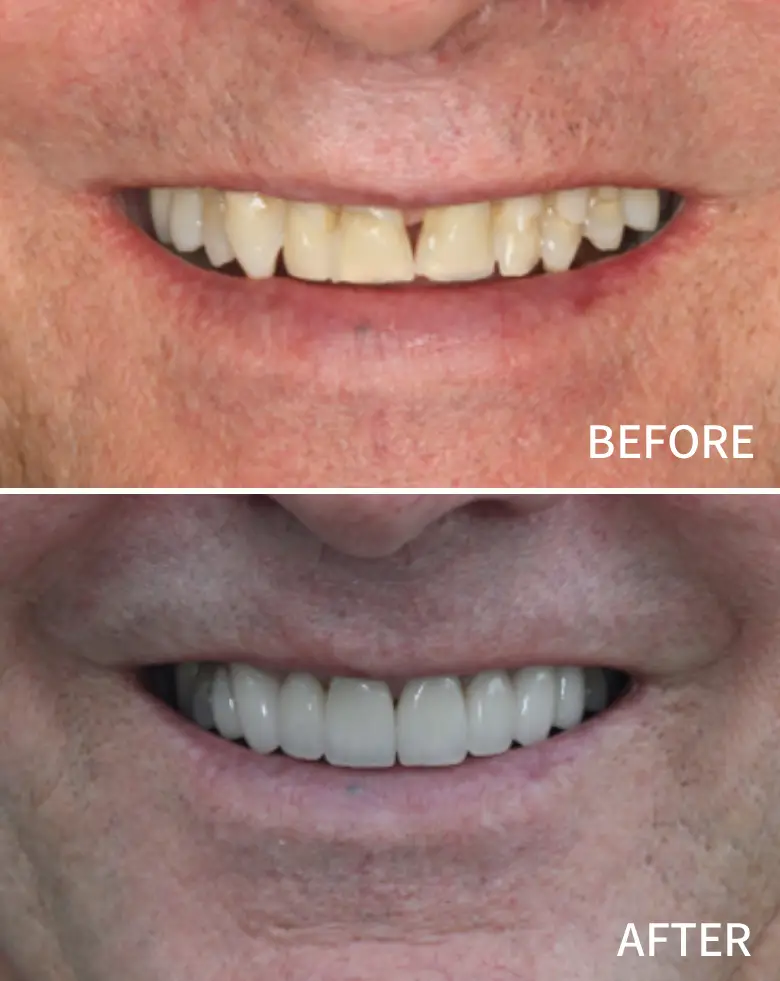 Before-and-after dental transformation showcasing improved smile aesthetics, addressing anterior tooth loss and diastema, highlighting successful cosmetic restoration by NuSmile Implant Studio.