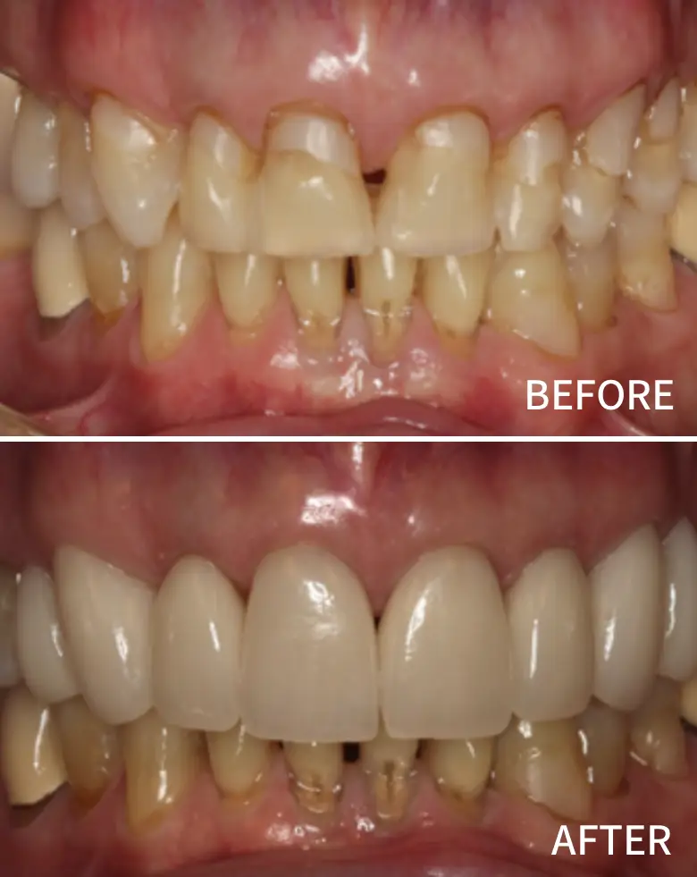 Before-and-after images of a smile transformation showcasing improved anterior teeth alignment and restoration, highlighting changes from diastema and generalized tooth wear.