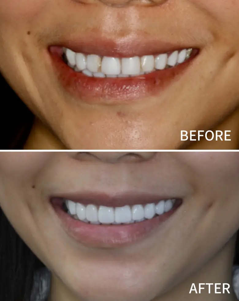 Before-and-after dental transformation showcasing improved smile aesthetics, highlighting treatment for diastema and anterior tooth loss.