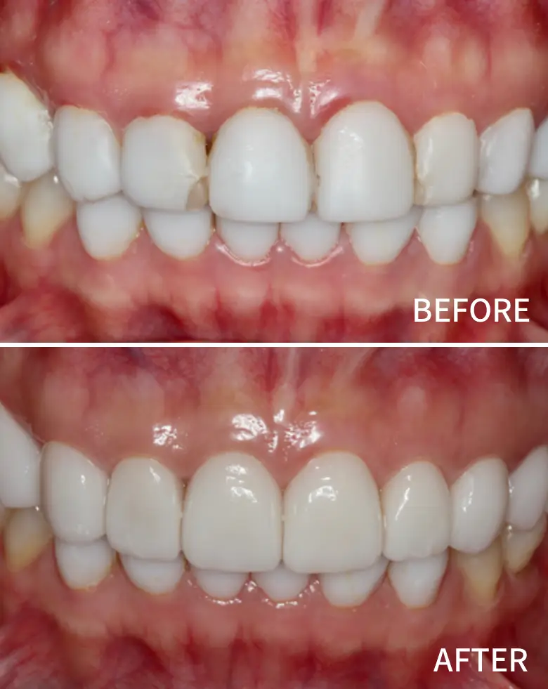 Before-and-after dental transformation showcasing successful treatment of anterior tooth loss and diastema, highlighting improved smile aesthetics and alignment.