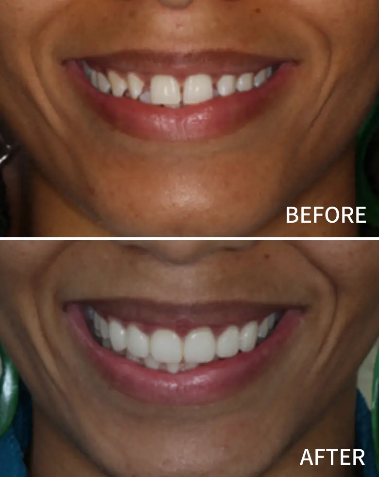 Before-and-after image showcasing a smile transformation, highlighting diastema closure and improved dental aesthetics through cosmetic dentistry at NuSmile Implant Studio.